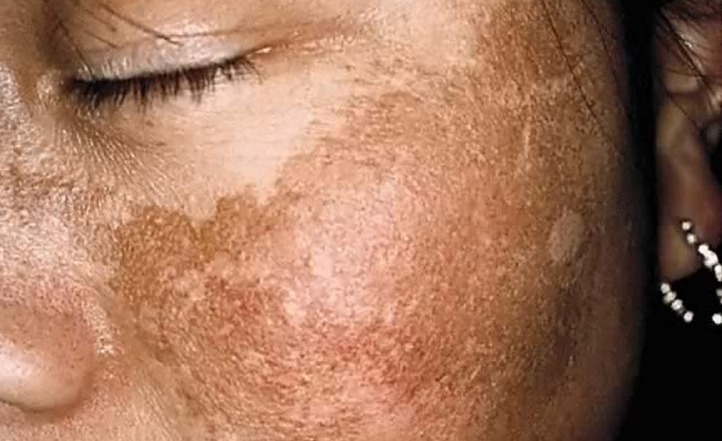 Common Skin Conditions in Black Skin